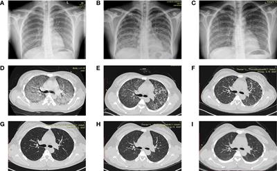 Analysis of Clinical Features and Risk Factors in Pregnant Women With Miliary Pulmonary Tuberculosis After In Vitro Fertilization Embryo Transfer